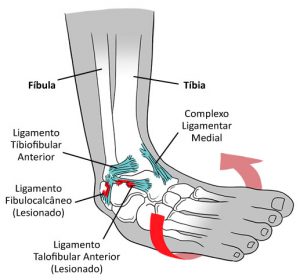 Entorse de Tornozelo