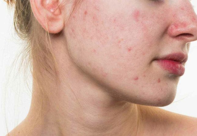 acne problemas mais comuns que afligem a pele